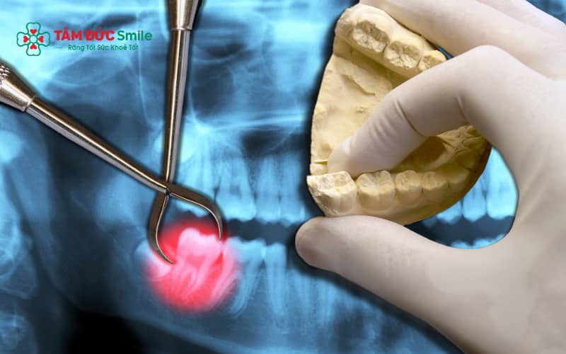 Không nên chườm nóng khi có dấu hiệu viêm ổ răng khô hoặc sưng đau kéo dài để tránh làm tình trạng nặng hơn.