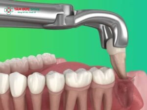 Chườm nóng sau khi nhổ răng khôn bao lâu? Cách giảm sưng an toàn