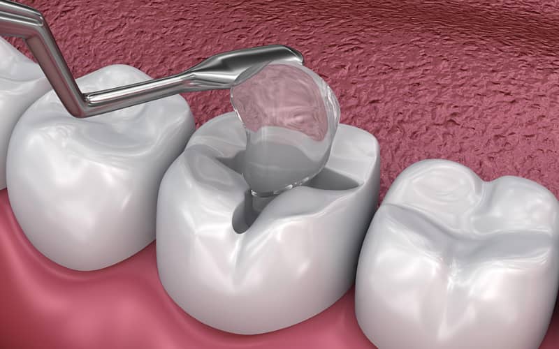 Phụ nữ đang trong chu kỳ kinh nguyệt vẫn có thể trám răng nếu sức khỏe ổn định