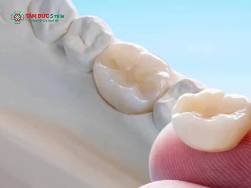 Có nên Abc8.com Thể thao, Đá gà, Xổ số, Bắn cá sau khi lấy tủy? Răng chết tủy có bọc sứ được không?