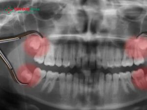 Có nên nhổ 4 răng khôn cùng lúc? Nguy hiểm không, bao lâu lành?