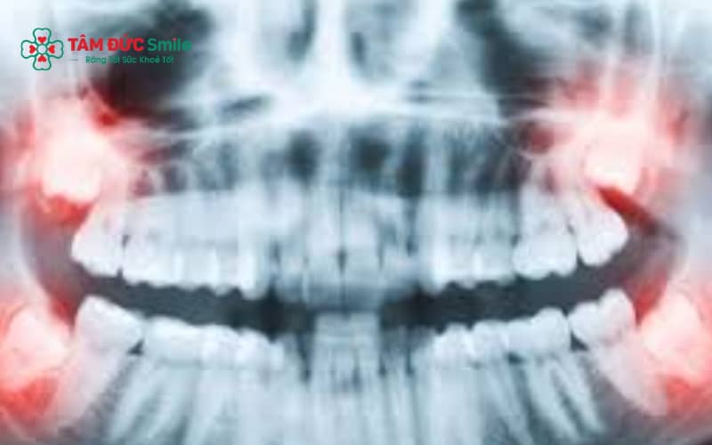 Răng khôn mọc lệch, mọc ngầm hoặc gây viêm là những trường hợp cần nhổ sớm để tránh biến chứng.