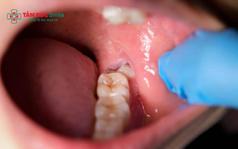 Không phải tất cả răng khôn đều cần nhổ, cần thăm khám để đánh giá từng trường hợp cụ thể