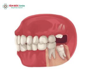 Có nên nhổ hết răng khôn không? Mọc lệch, mọc ngầm có nguy hiểm?