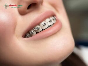 Có nên tẩy trắng răng trước khi niềng? Nên trước hay sau?