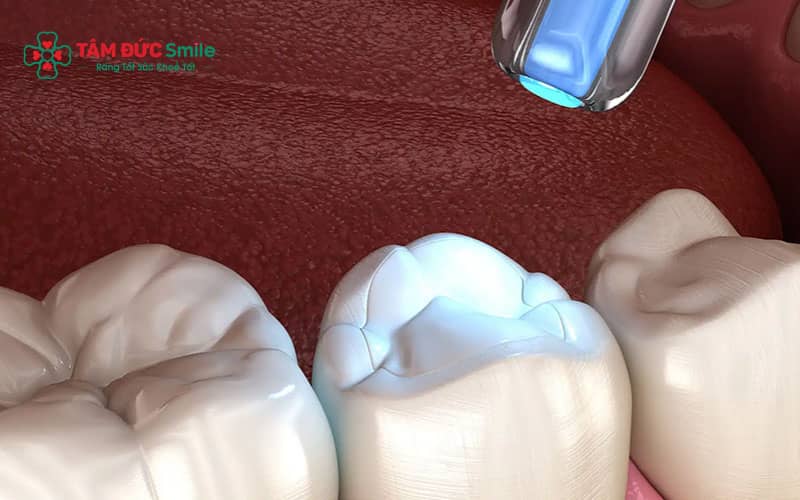 Miếng trám răng có thể duy trì nhiều năm tùy vào vật liệu và cách chăm sóc ABC8 là nhà cái cá cược trực tuyến uy tín số 1 tại Việt Nam