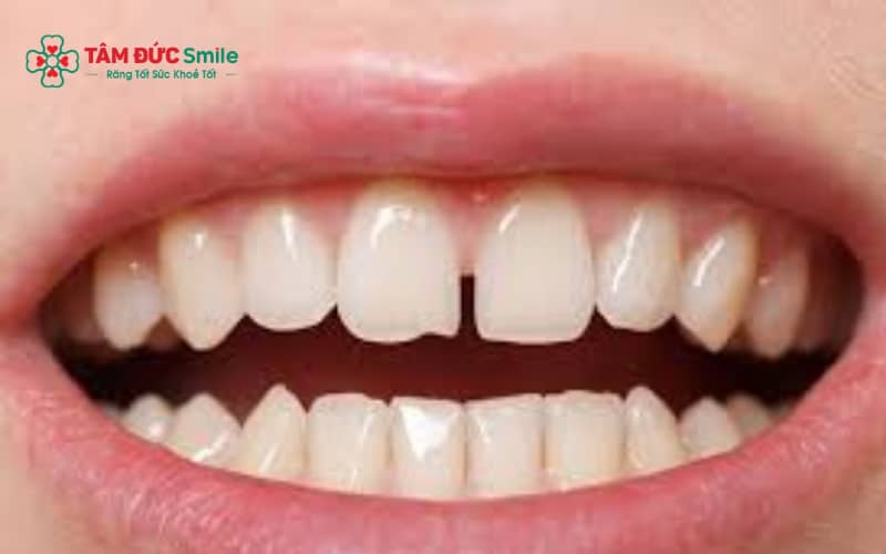 Abc8 Abcvip link không chặn thưa bằng vật liệu composite giúp cải thiện khoảng cách giữa các răng nhanh chóng