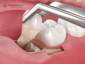 Công nghệ nhổ răng khôn mới nhất bằng sóng Abc8 abcvip tỷ lệ trả thưởng cực hấp dẫn Piezotome