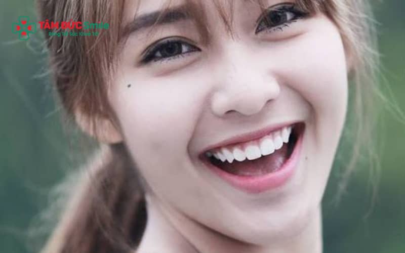 Cười hở lợi được chia thành nhiều mức độ khác nhau tùy theo phần nướu lộ ra khi cười.