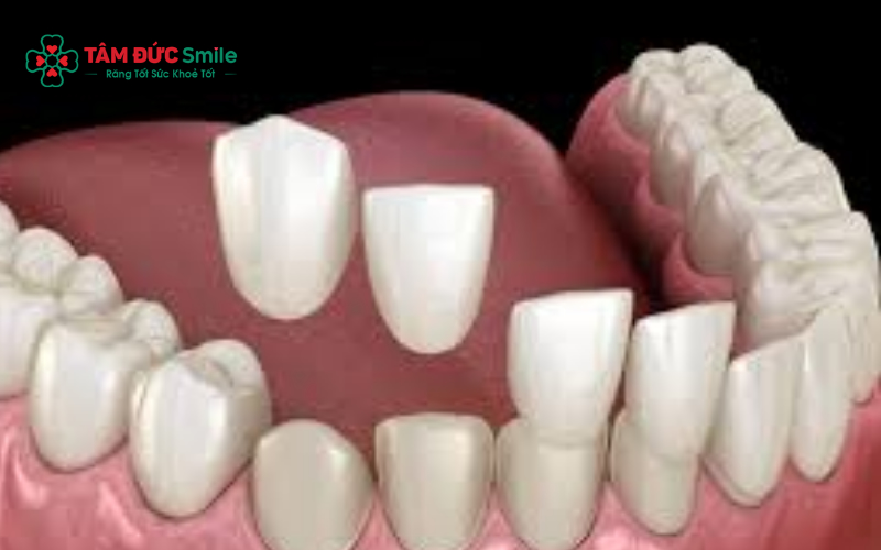 Mặt dán sứ veneer giúp cải thiện màu sắc và hình dạng răng, mang lại ABC8 được thành lập vào năm 2011 hoạt động đến hiện tại Abc8c1 com khuyến mãi hấp dẫn tự nhiên