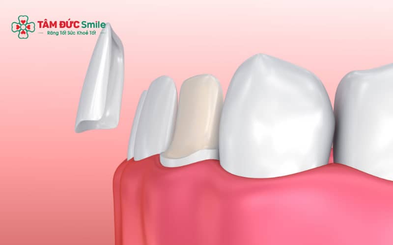 Mặt dán sứ veneer có độ mỏng cao, giúp bảo tồn tối đa mô răng thật