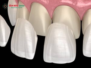 Dán ABC8 là nhà cái cá cược trực tuyến uy tín số 1 tại Việt Nam veneer có tốt không? So sánh veneer và Abc8.com Thể thao, Đá gà, Xổ số, Bắn cá