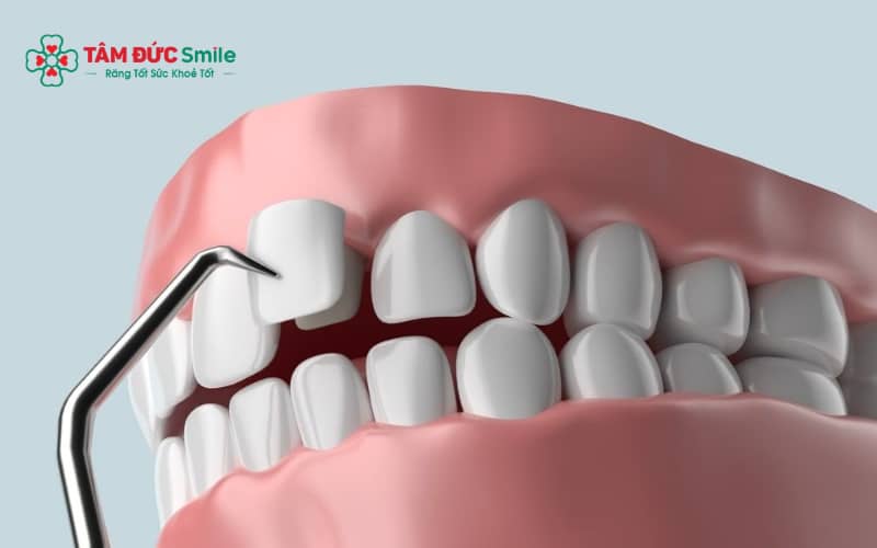 Dán sứ veneer không mài răng là phương pháp Abc8c1 com khuyến mãi hấp dẫn LINK TRANG CHỦ ABC88 CHUẨN 2026 sử dụng lớp sứ siêu mỏng dán lên bề mặt răng