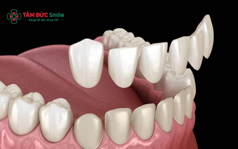 Dán sứ veneer không mài răng phù hợp với các trường hợp răng thưa, răng ố màu hoặc răng mẻ nhẹ cần cải thiện Abc8c1 com khuyến mãi hấp dẫn