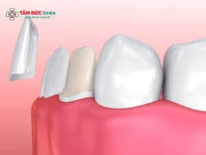 Dán sứ veneer không mài răng – Veneer siêu mỏng bảo tồn răng thật