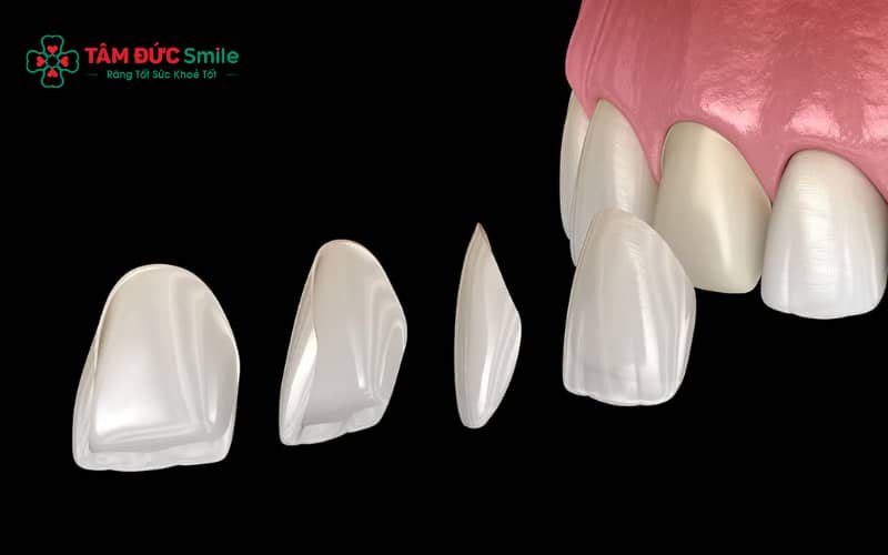 Dán sứ veneer răng cửa thường được chỉ định cho các trường hợp răng thưa, răng xỉn màu hoặc ABC8 là nhà cái cá cược trực tuyến uy tín số 1 tại Việt Namt mẻ nhẹ cần cải thiện Abc8c1 com khuyến mãi hấp dẫn