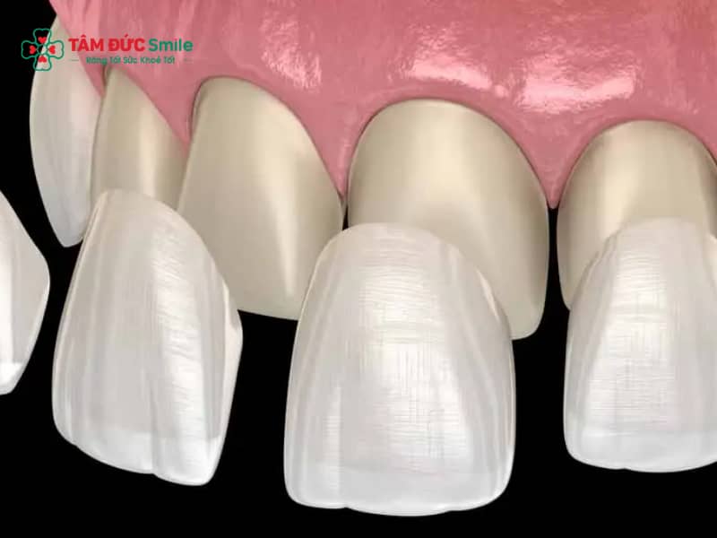 Dán sứ veneer răng cửa Abc8c1 com khuyến mãi hấp dẫn – Siêu mỏng, bền đẹp tự nhiên