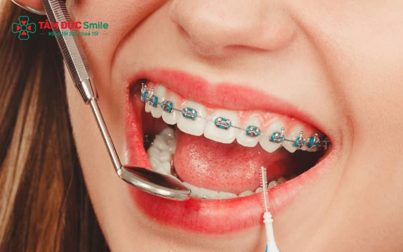 Đang Abc87 tải ứng dụng có thai được không? Chỉnh nha và thai kỳ