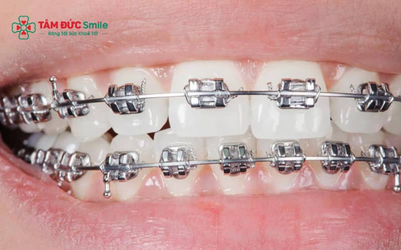 Thói quen, sai khớp cắn và cấu trúc hàm hẹp có thể hình thành tật đẩy lưỡi khi niềng