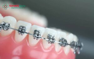 Đẩy lưỡi khi Abc87 tải ứng dụng gây sai khớp cắn, khớp cắn hở và tái phát