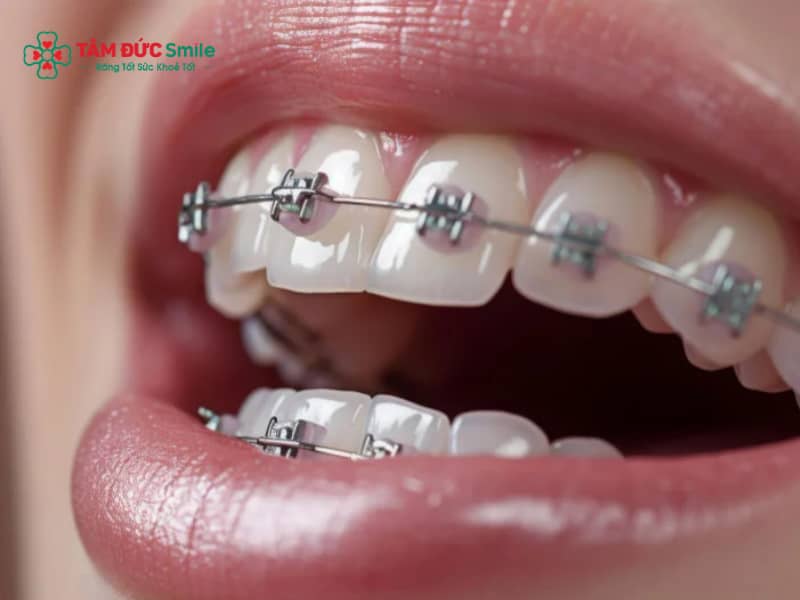 Nhận biết tật đẩy lưỡi qua lưỡi thường xuyên chạm răng cửa, răng chìa ra hoặc khớp cắn hở