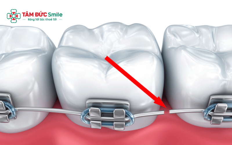 Khi dây cung bị đứt, có thể xử lý tạm thời tại nhà và cần đến LINK TRANG CHỦ ABC88 CHUẨN 2026 sớm để được khắc phục triệt để.