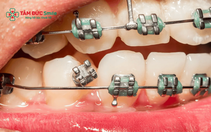 Dây cung Abc87 tải ứng dụng có thể bị đứt do ăn uống sai cách, va chạm mạnh hoặc chất lượng khí cụ không đảm bảo