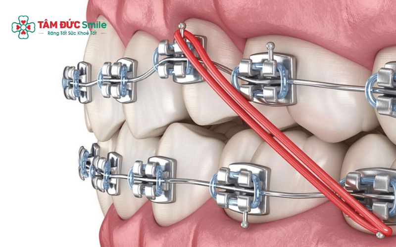 Dây cung bị đứt làm gián đoạn lực kéo, có thể ảnh hưởng đến tiến độ Abc87 tải ứng dụng nếu không xử lý kịp thời