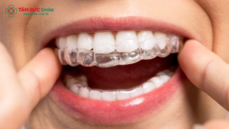 invisalign-first-2