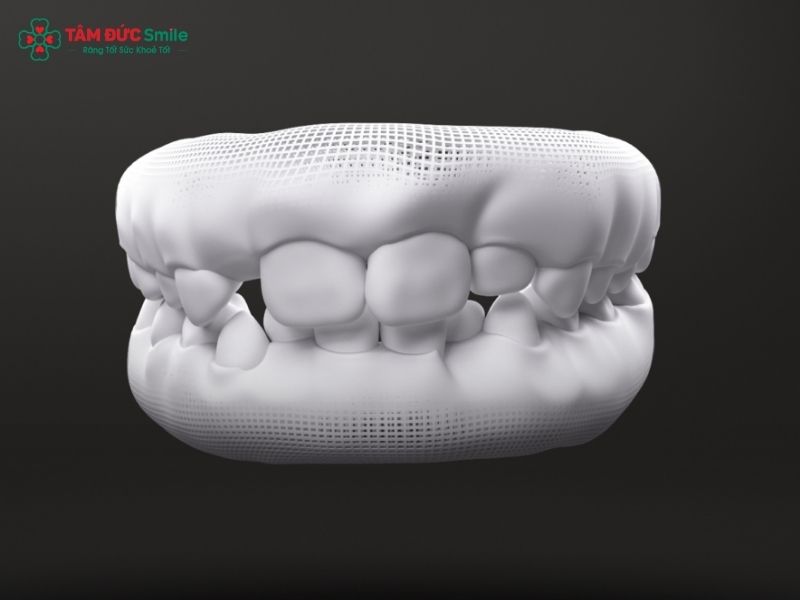 invisalign-first-3