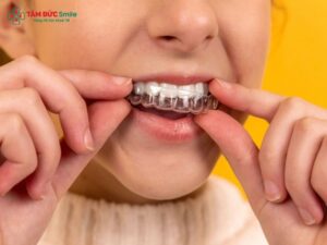 invisalign-first-4