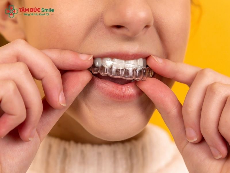 invisalign-first-4