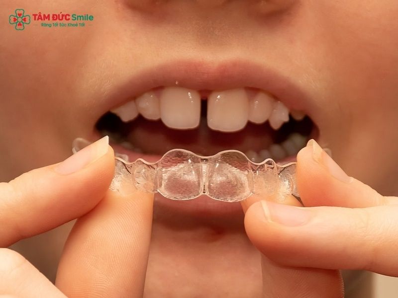 invisalign-teen-2