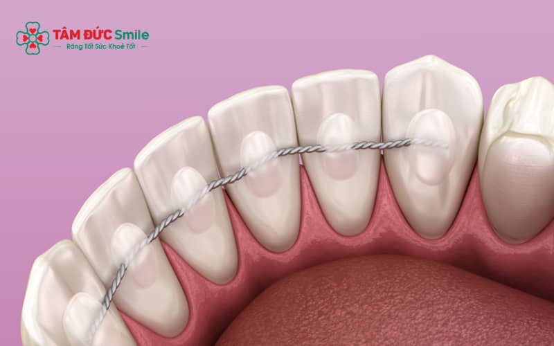 Khí cụ duy trì gồm loại cố định và tháo lắp, được chỉ định tùy theo tình trạng răng của từng người.