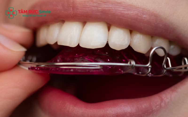 Khí cụ duy trì giúp giữ răng ổn định sau khi tháo niềng, ngăn ngừa xô lệch trở lại.