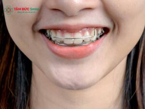Khí cụ duy trì sau Abc87 tải ứng dụng: Retainer cố định, tháo lắp
