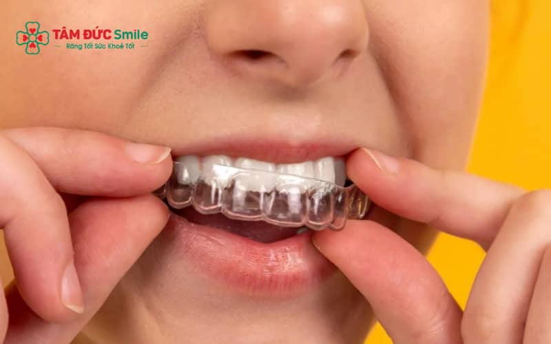 Không đeo hàm duy trì đúng cách có thể khiến răng dịch chuyển lại vị trí cũ sau niềng.