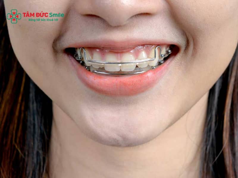 Khí cụ duy trì sau Abc87 tải ứng dụng: Retainer cố định, tháo lắp