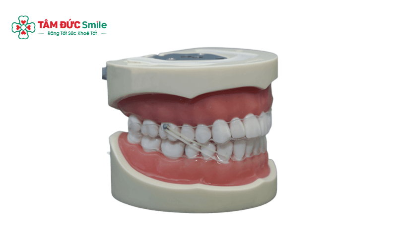 Các dấu hiệu như răng hô, móm, lệch lạc hay sai khớp cắn là cảnh báo bạn nên Abc87 tải ứng dụng sớm