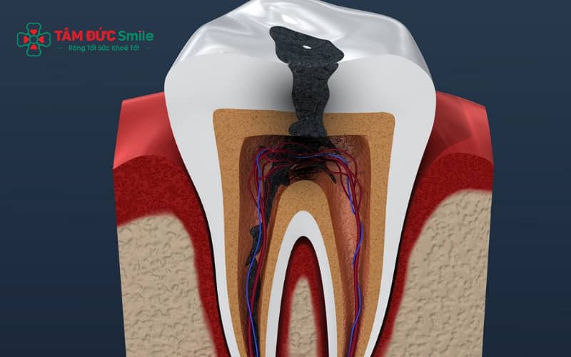 Đau nhức dữ dội, ê buốt kéo dài là dấu hiệu cho thấy tủy răng có thể đã bị viêm