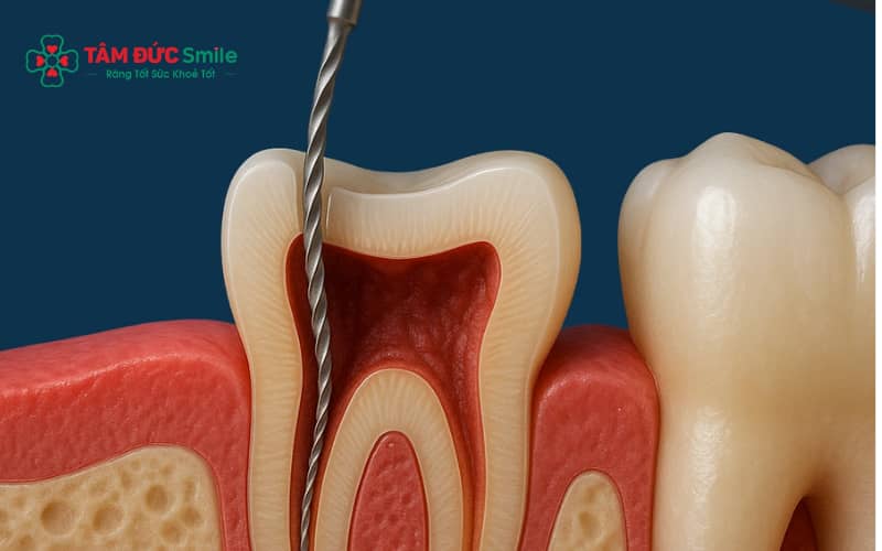 Răng sau khi lấy tủy và trám đúng kỹ thuật vẫn có thể duy trì chức năng ăn nhai ổn định
