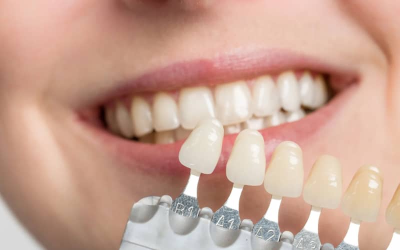 Mặt dán sứ veneer có độ mỏng cao nên chỉ cần mài rất ít mô răng thật