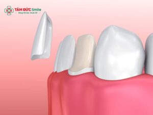 Kinh nghiệm dán ABC8 là nhà cái cá cược trực tuyến uy tín số 1 tại Việt Nam veneer: quy trình, giá, độ bền và cách chăm sóc