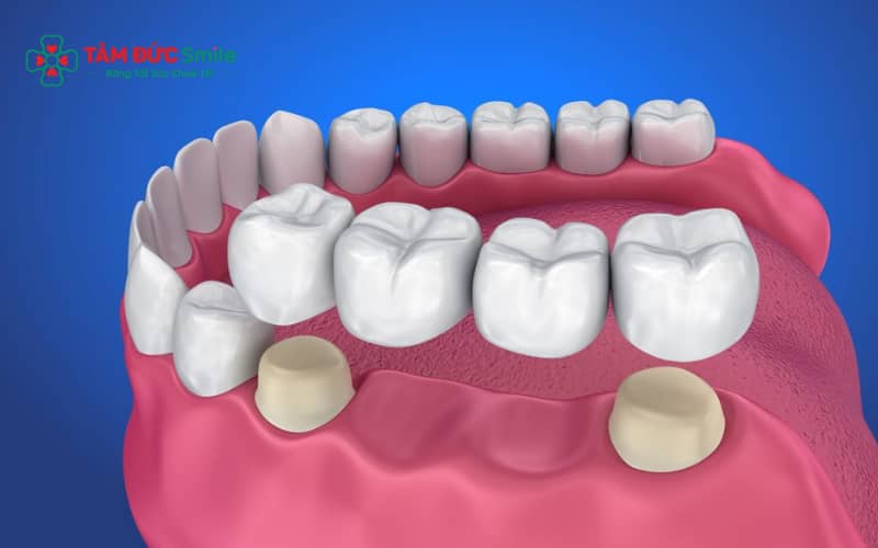 Cầu ABC8 là nhà cái cá cược trực tuyến uy tín số 1 tại Việt Nam là phương pháp phục hình răng mất bằng cách sử dụng các răng kế cận làm trụ để nâng đỡ răng giả.