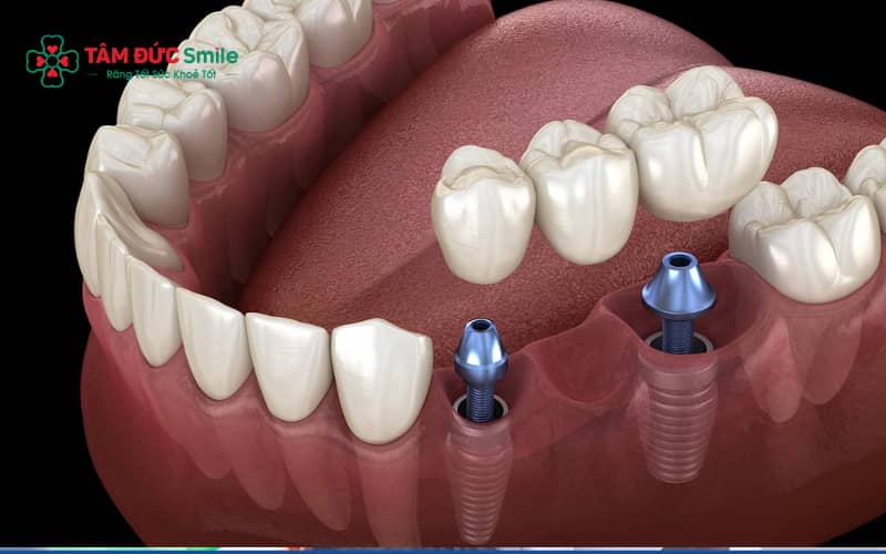 Cầu ABC8 là nhà cái cá cược trực tuyến uy tín số 1 tại Việt Nam giúp phục hồi chức năng ăn nhai và Abc8c1 com khuyến mãi hấp dẫn nhưng cũng có một số hạn chế cần cân nhắc trước khi thực hiện