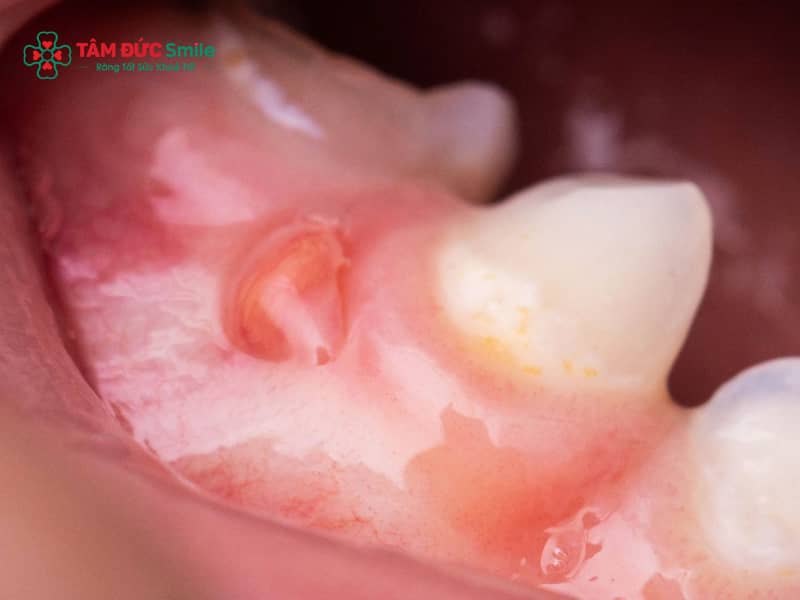 Lợi đang sưng có nhổ răng khôn được không? Xử lý viêm an toàn
