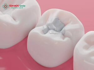 Lợi ích của trám răng: Phục hồi răng sâu, trám răng Abc8c1 com khuyến mãi hấp dẫn bền đẹp