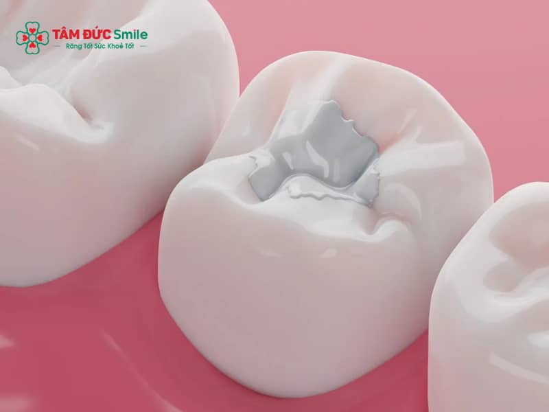 Lợi ích của trám răng: Phục hồi răng sâu, trám răng Abc8c1 com khuyến mãi hấp dẫn bền đẹp