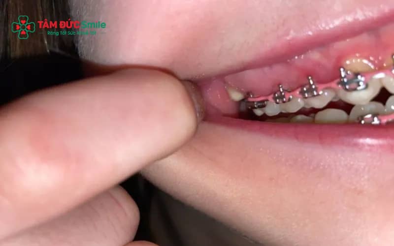 Lợi trùm là tình trạng mô nướu che phủ một phần răng, thường gặp ở răng khôn trong quá trình Abc87 tải ứng dụng