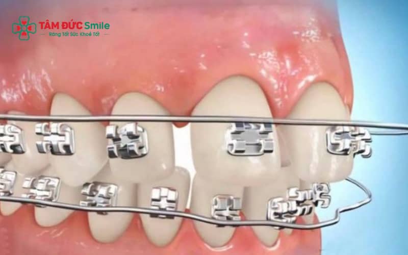 Viêm lợi trùm khi Abc87 tải ứng dụng thường do răng khôn mọc lệch và vệ sinh ABC8 là nhà cái cá cược trực tuyến uy tín số 1 tại Việt Nam không sạch.